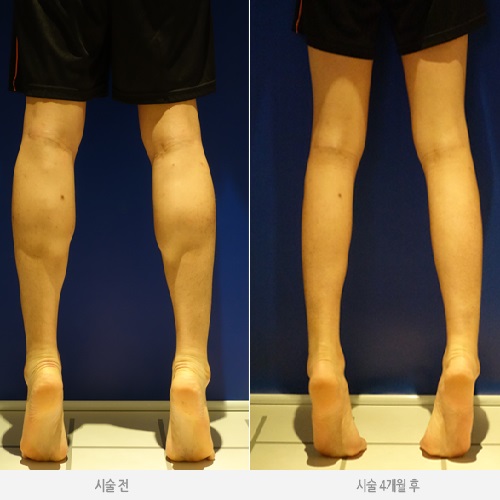 韓国で美脚 脚やせ ふくらはぎ 太もも整形をお考えならハフィス